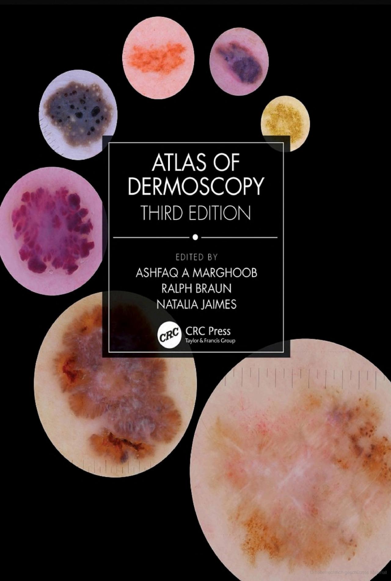 Atlas of Dermoscopy - Third edition | Dermoscopedia